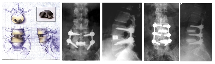 gerincstabilizáló műtét